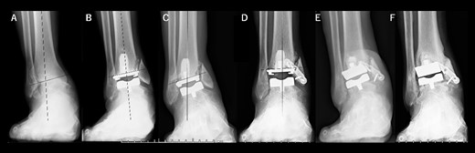 Radiographs of preoperative weight-bearing radiograph of the antero-posterior ankle joint in Case 1. (A) Preoperative. Talar tilt is 11° varus. Opening of the lateral gutter with os subfibulare is seen. (B) One month after surgery. Medial malleolar osteotomy without internal fixation, and tibial component placed in the 5° varus position. Opening of the lateral gutter still remains. (C) Five months after surgery. The tibial component shows varus migration, and nonunion at the medial malleolar osteotomy has occurred. Opening of the lateral gutter is exacerbated. (D) One month after revision surgery. The site of the medial malleolar osteotomy is fixed with a mini-plate, and varus positioning of the tibial component still remains (3° varus). The lateral gutter is closed. (E) Three months after revision surgery. Varus migration of the tibial component has occurred again, and bone union at the osteotomy is still not seen. (F) Four years after revision surgery. Bone union has been achieved, but both tibial and talar components show malposition. The lateral gutter is still closed.
