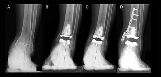 Radiographs of preoperative weight-bearing radiograph of the antero-posterior ankle joint in Case 2. (A) Preoperative. Talar tilt is 17° varus. Opening of the lateral gutter is seen. (B) One month after surgery. Medial malleolar osteotomy without internal fixation and the tibial component placed in the 2° varus position. Opening of the lateral gutter remains. (C) Three years after surgery. Varus migration of the tibial component has progressed after the patient missed the stairs (7° varus position of the component), and nonunion at the medial malleolar osteotomy has occurred. Opening of the lateral gutter has also remained. (D) Three months after revision surgery. Medial malleolar osteotomy site is fixed with a plate, and varus positioning of the tibial component still remains (3° varus). The lateral gutter is closed.