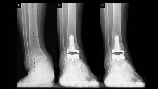 Radiographs of preoperative weight-bearing radiograph of the antero-posterior ankle joint in Case 3. (A) Preoperative. Talar tilt is 21° varus. Opening of the lateral gutter is seen. (B) One month after surgery. Medial malleolar osteotomy without internal fixation and the tibial component placed in the 4° valgus position, unlike the other two cases. The lateral gutter is closed. (C) Five years after surgery. There is no evidence of prosthetic loosening, even though incomplete bone union at the osteotomy site is seen. The lateral gutter is still closed.