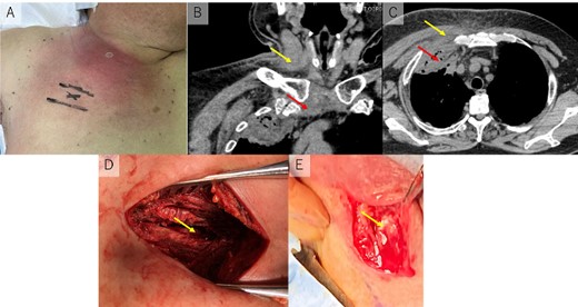 (A) Erythematous skin changes in the right anterior chest, neck, and shoulder. (B) The abscess was found in the right sternoclavicular joint (lower arrow) and right sternocleidomastoid muscle (upper arrow). (C) The abscess in the anterior chest wall (upper arrow) extended into intrathoracic space (lower arrow). (D) Surgical drainage was undergone for anterior chest wall and intrathoracic space (arrow). (E) The sternocleidomastoid muscle was split along the muscle fiber, and purulent collection was drained from the entire muscle (arrow).