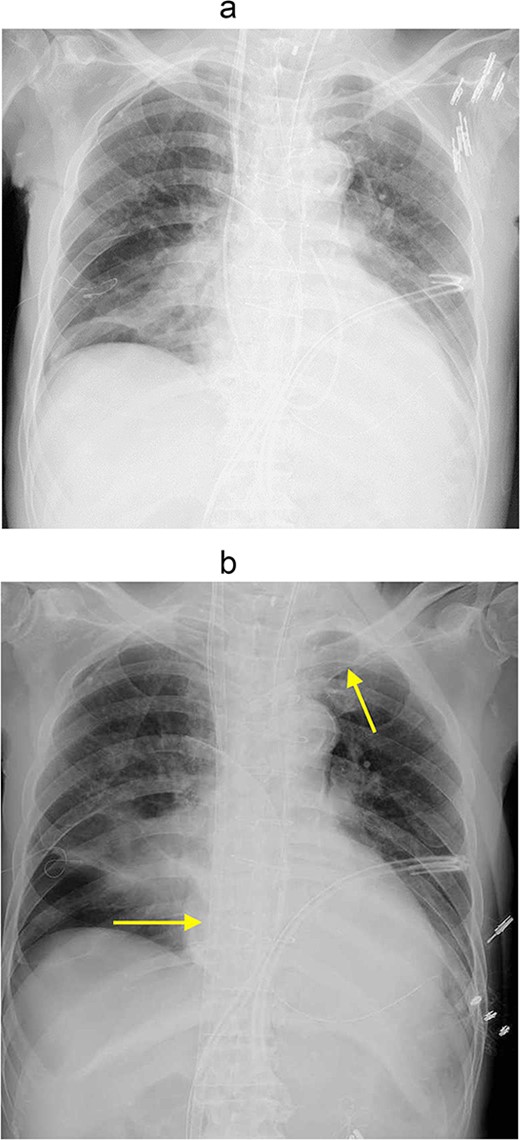 (a) Chest Xp immediately after the operation. (b)