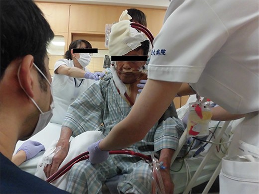 Photograph of the patient with VV-ECMO without intubation.
