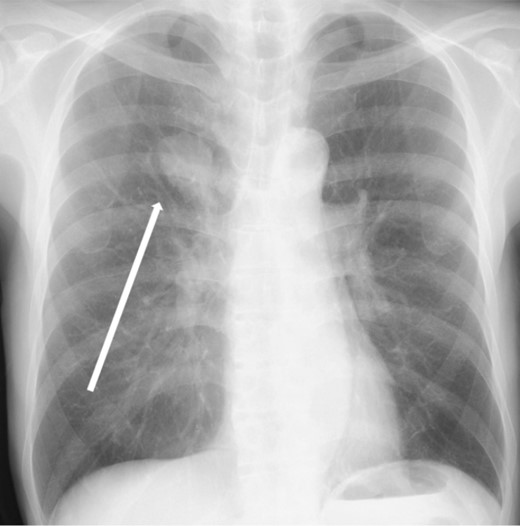 Chest X-ray findings (frontal view). Mass shadow in the upper lobe of the right lung.