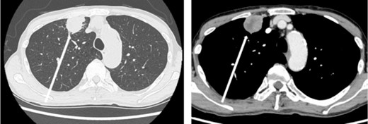 Chest computed tomography (CT) findings. An irregular mass 43 × 33 × 28 mm in size was found in the upper lobe of the right lung, which was suspected to be primary lung cancer.