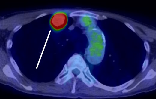 18F-fluorodeoxyglucose positron emission tomography findings. Abnormal accumulation of Max SUV 28.4 was found in a pointed lesion in the right upper lobe of the lung, which was considered to be a primary lung cancer site.