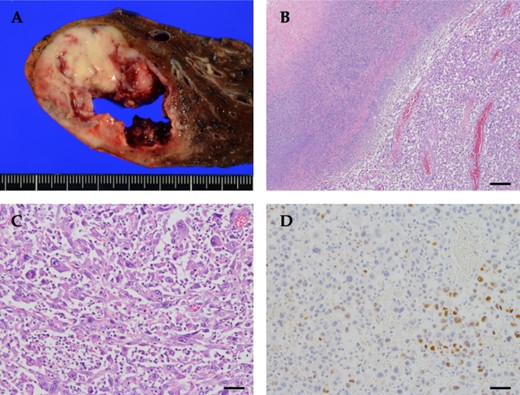Pathological findings of the tumor. (A) Grossly, a tan to yellowish tumor with necrosis was observed. (B) The tumor cells were less cohesive, accompanied by abscess and necrosis (top left). (C) The tumor was composed of spindle-shaped cells, polygonal cells with bizarre nuclei, and multinucleated giant cells, with prominent neutrophil infiltration between tumor cells. (D) Tumor cells were focally positive for TTF-1. Scale bar: (B) 250 μm, (C and D) 50 μm.