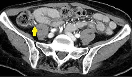 CT scan demonstrating an appendicolith (proven by pathology to be fecalith) at the base of the appendix.