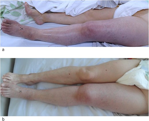Photograph of the affected leg. (a) At the day of admission. The left leg appears pale and swollen. The superficial veins are occluded. (b) One day after admission. The color of the skin and occlusion of the superficial vein appears improved. Swelling of the leg is still observed.