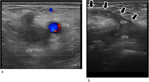Duplex ultrasound image at arrival. (a) Transverse image. (b) Longitudinal image. The common femoral and GSV (arrow mark) are occluded by thrombi. CFA, common femoral artery; CFV, common femoral vein; GSV, great saphenous vein.