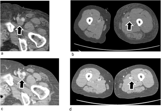 Enhanced CT. (a, b) One day after admission. The thrombus in the GSV has disappeared. However, thrombi are still observed in the deep veins, which remain totally occluded. (c, d) On Day 7. The thrombi in the deep veins have shrunk, and the veins have recanalized. Arrow marks indicate femoral veins.