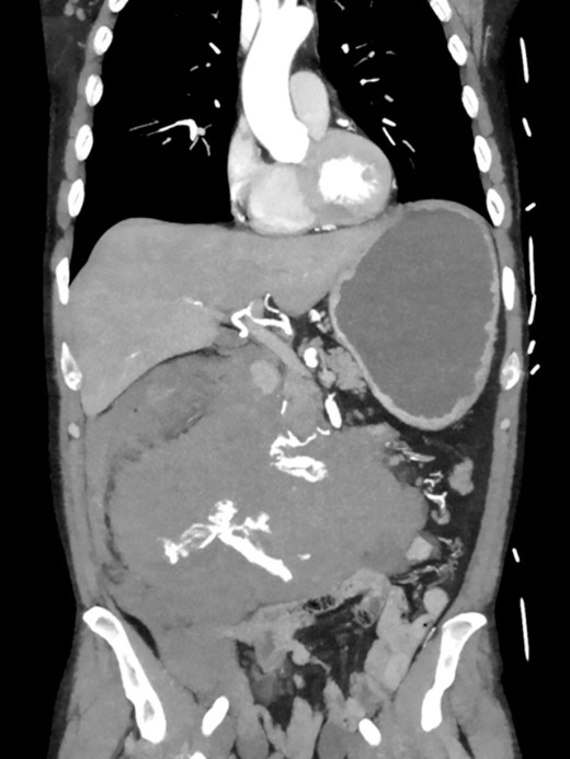 CTA showing an active bleeding likely from the pancreaticocuodenal artery with venous pooling and a large retroperitoneal hematoma.