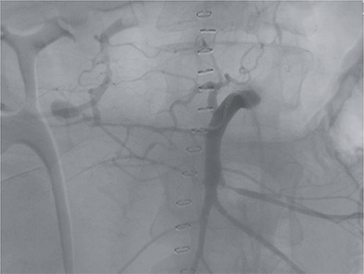 Angiography revealing the aneurysm of the pancreaticoduodenal arcade.