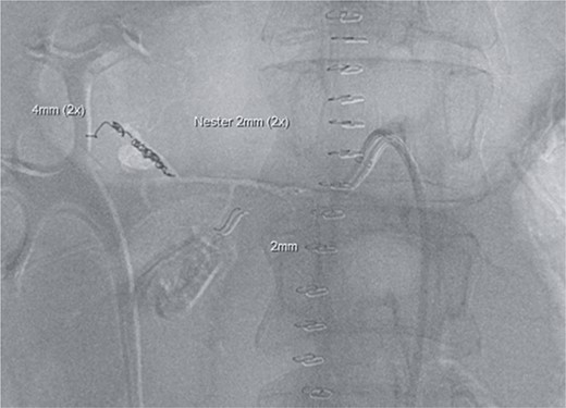 Postinterventional angiography, showing the aneurysm of the pancreaticoduodenal arcade, after interventional coiling.