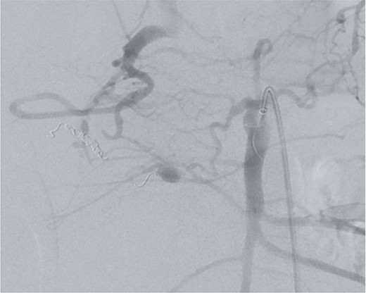 Angiography showing another aneurysm with active bleeding, proximally to the previously coiled site.