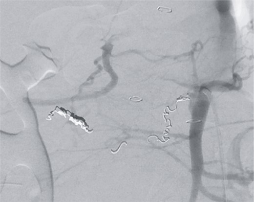 Postinterventional angiography, after interventional bleeding control, using coiling.