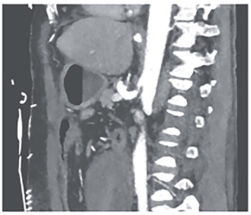 CTA showing a relevant stenosis of the celiac trunk.