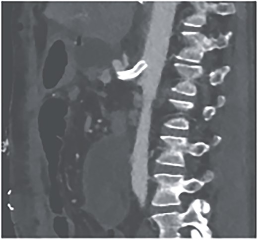 CTA showing successful intravascular sentient of celiac trunk.
