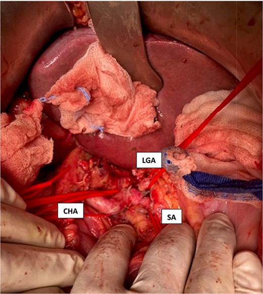 Intraoperative visualization of the coeliac trunk and its branches before decompression of the arcuate ligament (LGA = left gasric artery, CHA = common hepatic artery, SA = splenic artery).
