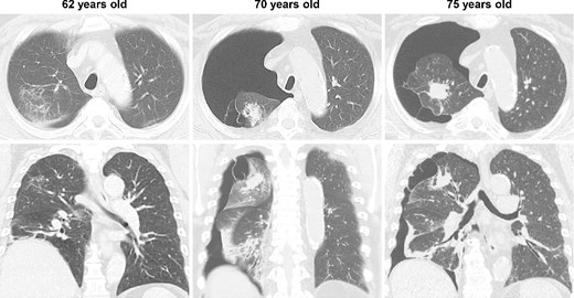 CT imaging findings; at age 62, shadows suggesting pulmonary infiltration were present in the upper lobe of the patient’s right lung, but no pulmonary cysts were observed; at age 70, the patient developed spontaneous pneumothorax in his right lung; another scan revealed a 3.2 cm lung mass with satellite lesions in the upper lobe of the right lung, as well as pulmonary cysts on the peripheral side of the mass; at age 75, the patient experienced a relapse of the spontaneous pneumothorax in the same lung.