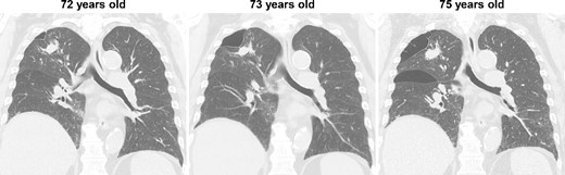 CT images of the intervening period between the initial and relapsed pneumothorax; no enlargement of the lung mass was observed, but gradual enlargement of the pulmonary cysts was apparent.