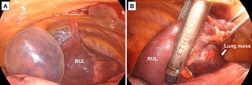 Surgical findings; (A) pulmonary cysts were observed in the upper lobe of the patient’s right lung; (B) the lung mass and pulmonary cysts were removed using a surgical stapler; RUL, right upper lobe.