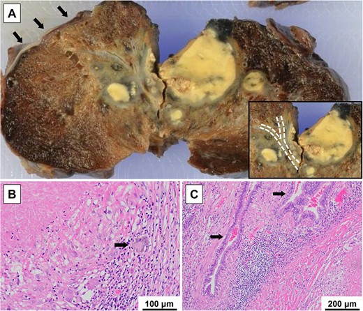 Macroscopic and histopathological findings; (A) a pale-yellow lung mass surrounding the bronchioles (dotted lines) and pulmonary cysts (arrows) on the peripheral side of the mass were observed; (B) a caseous granuloma with multinucleated Langhans giant cells (arrow) and accumulation of lymphocytes was observed; this was diagnosed as a pulmonary tuberculoma, after considering the result of a PCR test; (C) lymphocyte infiltration and fibrosis of the interstitial tissue associated with chronic inflammation were observed around the bronchioles (arrows); neither bronchial obstruction caused by the lung mass nor emphysematous changes in the background lung were observed.