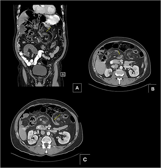 (A and B) Two separate CT images showing mesenteric swirling in distal small bowel and colon. (C) CT image showing severe luminal narrowing of distal transverse colon.