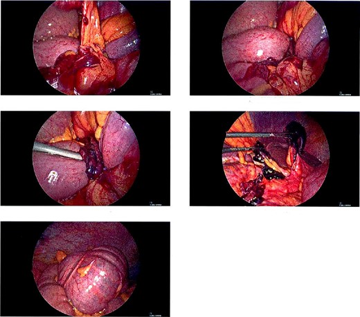 Intraoperative pictures of thick necrotic/adhesive band arising from colon mesentery entrapping band. Cecal bascule found in the RUQ.