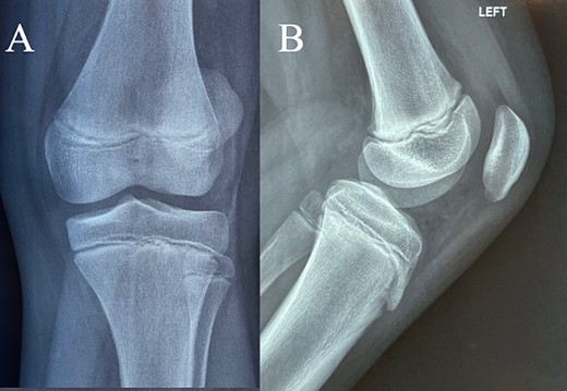 (A + B) Antero-posterior and lateral X-ray examination of the injured knee. Radiological examination shows no fracture.