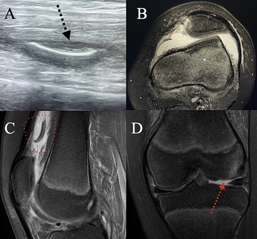 (A) Ultrasound examination of the supra-patellar pouch revealed a possible chondral fragment floating there. (B) Axial MRI showing lateralization of the patella, trochlea dysplasia and a torn MPFL. (C) Sagittal MRI confirming that there is a chondral fragment in the supra-patellar pouch. (D) Coronal MRI showing the chondral fracture in the lateral femoral condyle.