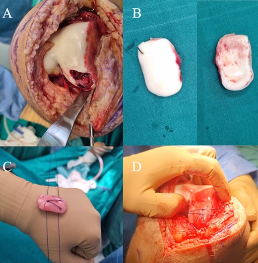 (A) Intra-operative image of the chondral fracture in the lateral femoral condyle. (B) The chondral fragment that was retrieved from the supra-patellar pouch. The fragment exhibited no attachment to subchondral bone. (C) The suture passage on the chondral fragment is created in a triangle fashion. The small holes visible are a result of attempts to suture the edges and to stabilize the fragment with various types of bioabsorbable constructs, all of which failed to stabilize the fragment. (D) Intra-operative view of the suture-bridge technique described in the article, which provides strong compression and stabilization of the fragment.