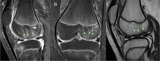 (A + C) Sagittal and (B) coronal MRI views 4 months post-operatively. The arrows indicate healing of the chondral fracture, although some minor subchondral abnormalities are present.