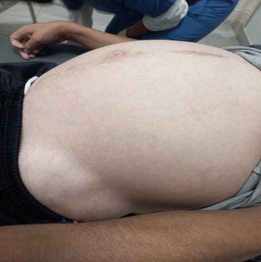 The patient’s abdomen at admission B.