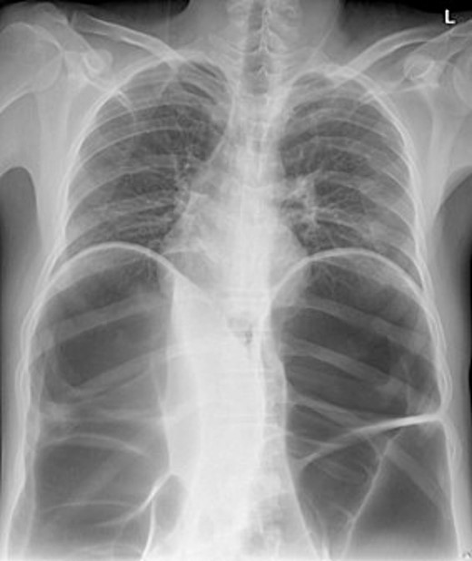 Chest X-ray.