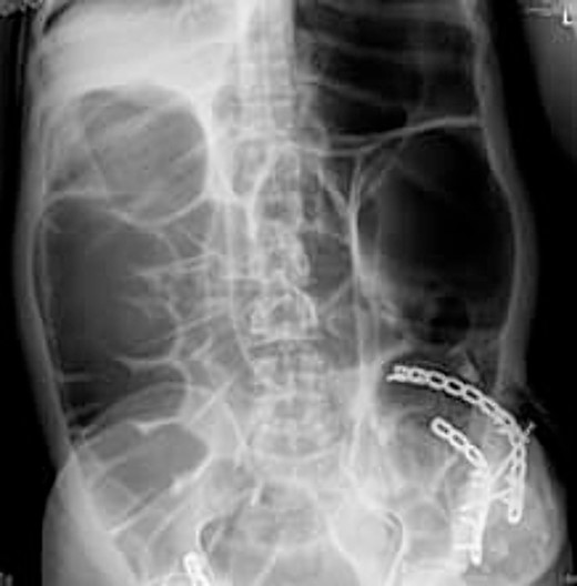 Erect abdomen X-ray.