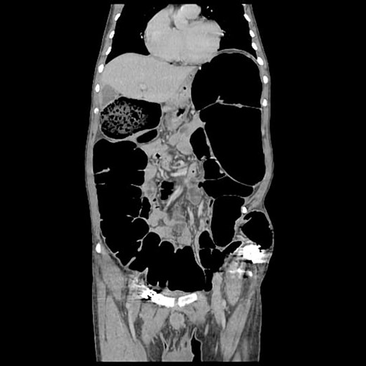 Corona l abdominal CT scan.