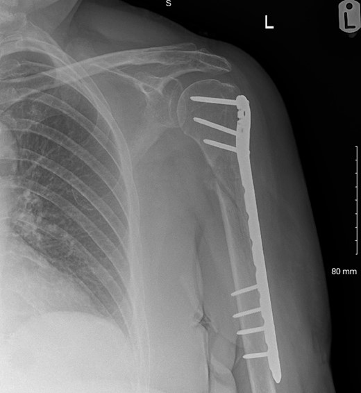 Post-operative radiographs following humerus fixation.