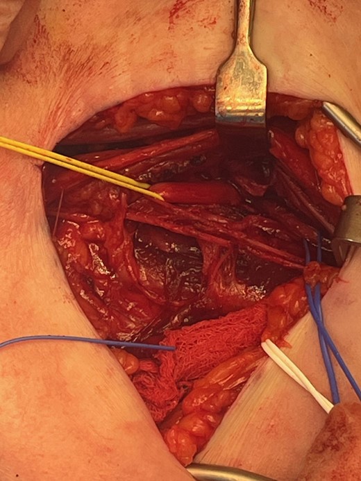 Left radial nerve identified proximally with yellow sling and distally with blue sling showing compression below the Arthrex FiberTape® Cerclage.