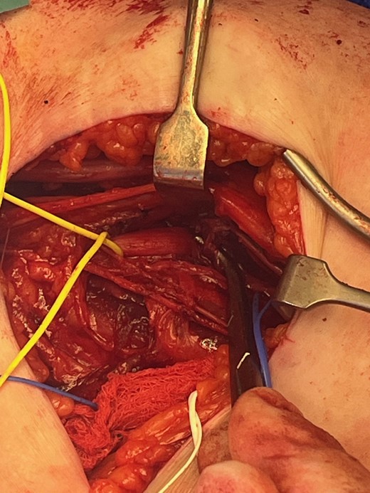 Arthrex FiberTape® Cerclage isolated at site of compression.