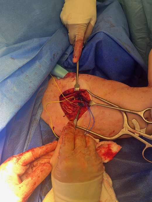 Severe radial nerve axonal injury with epineurial loss and exposed fascicles.