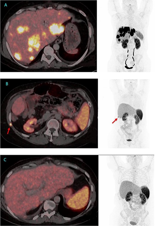 64Cu-DOTATATE PET/CT from 2 June 2022, 7 weeks before LT with extensive hepatic involvement but no extrahepatic metastases (A). 64Cu-DOTATATE PET/CT 15 months after LT revealed an implantation metastasis in the thoracic wall (B). Latest 64Cu-DOTATATE PET/CT performed 18 months after LT and 3 months after resection of the thoracic metastasis showed no signs of recurrence (C).
