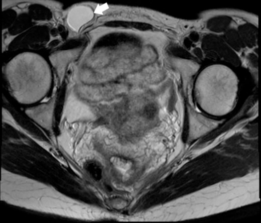 MRI of the Cyst of the Canal of Nuck–T1 sequence. This image highlights the cyst (indicated by the white arrow) within the inguinal region.