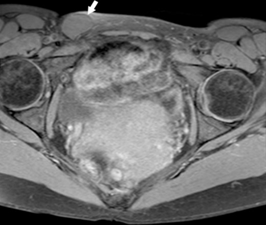 MRI of the Cyst of the Canal of Nuck–T2 sequence. This figure displays the cyst (indicated by the white arrow), showcasing its appearance on a T2-weighted image.