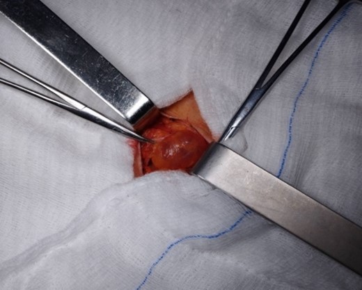 Intraoperative view of the cyst of the Canal of Nuck. This image directly represents the cyst during surgical excision and offers valuable insights into its size and location.