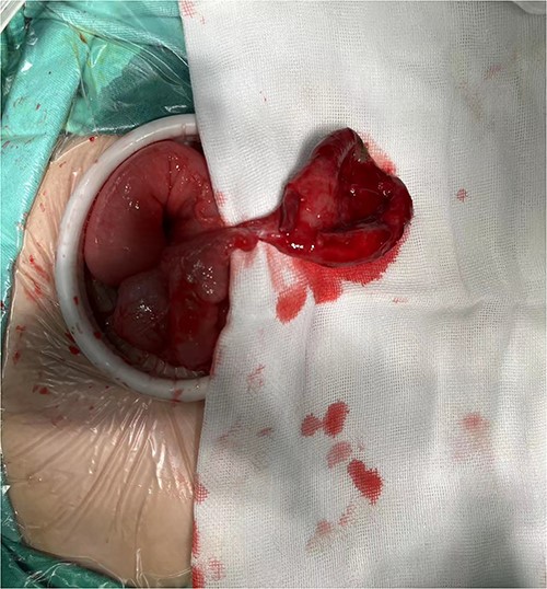 The shape of diverticulum.