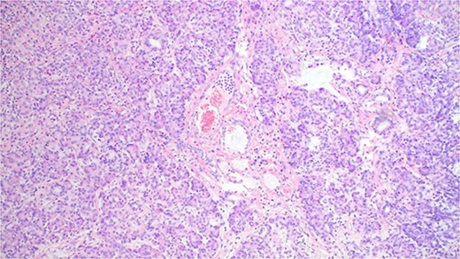 The pathology result of chronic diverticulitis with ectopic pancreatic mucosa.