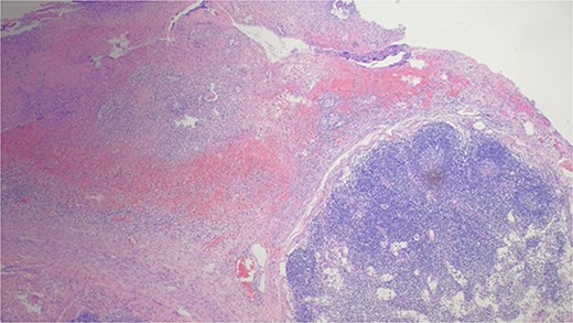 The pathology results of chronic appendicitis.
