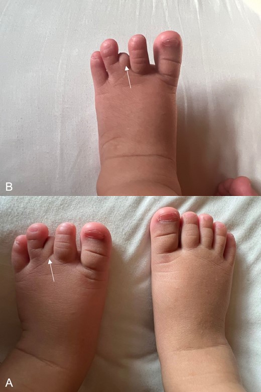 (A) Bilateral feet with normal right foot and left foot (arrow). (B) Hypoplastic left third toe with no visualization of the whole digit and absence of toenail (arrow).
