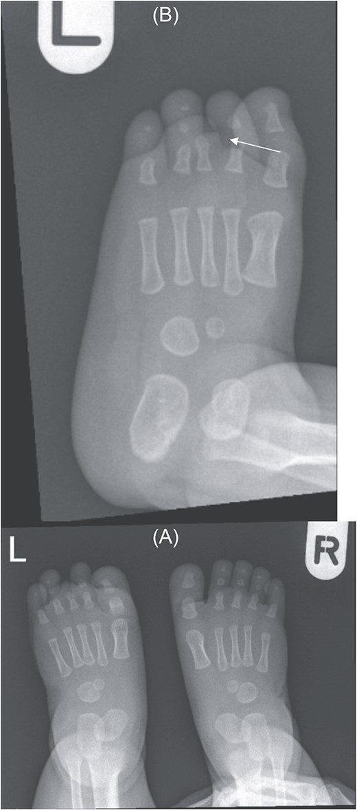 (A) Bilateral feet X-ray with normal right foot bone anatomy and left foot X ray. (B) No visualization of third toe middle and distal phalanges (arrow).