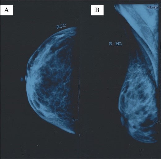 Right breast mammogram without pathological findings: (A) right craniocaudal (RCC) view and (B) right mediolateral (ML) view.